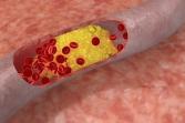 Cholesterol