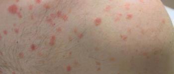 Psoriasis