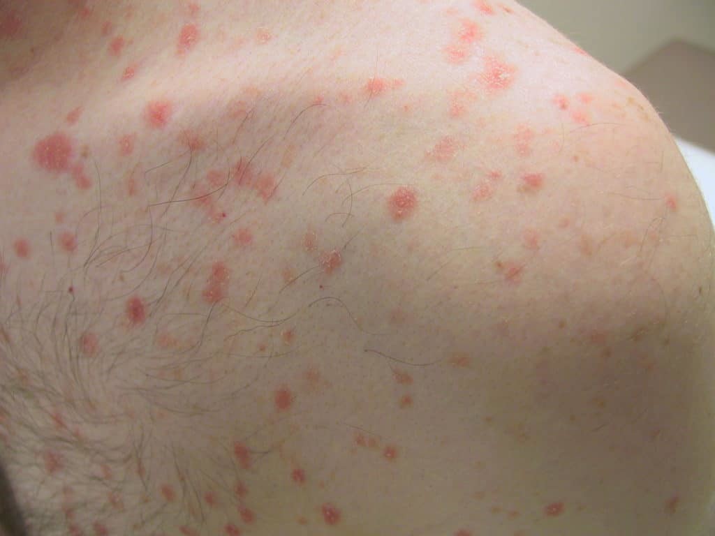 Psoriasis