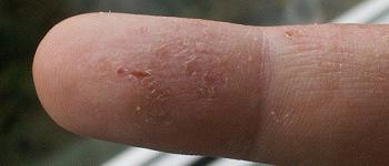 Contactallergie
