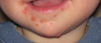 Coxsackievirus - Hand-, voet- en mondziekte