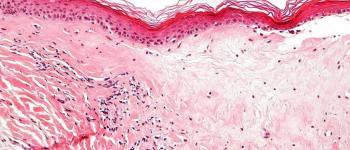 Lichen sclerosus