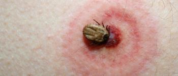 Lyme