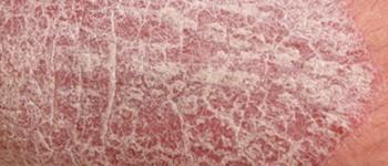 Psoriasis