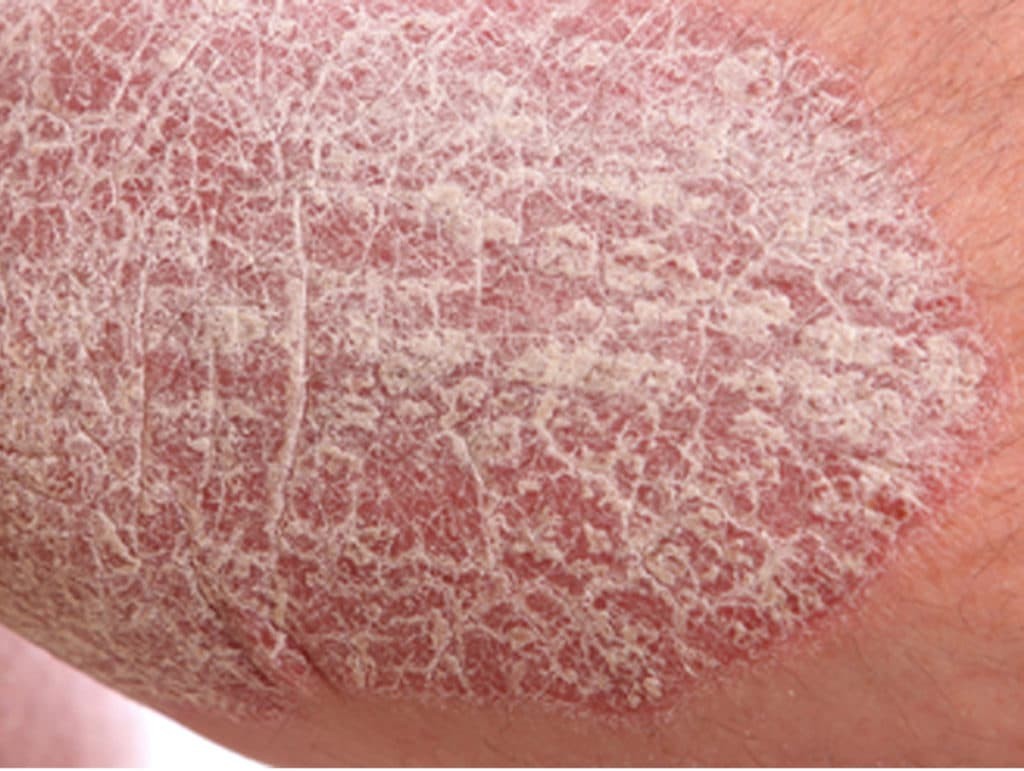 Psoriasis