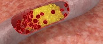 Cholesterol