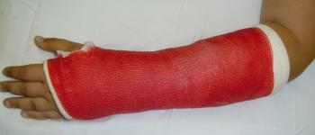 Gebroken arm
