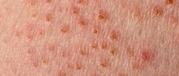 lichen planus