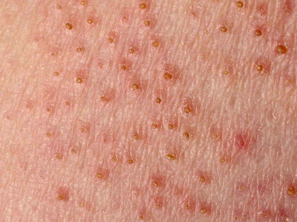 lichen planus